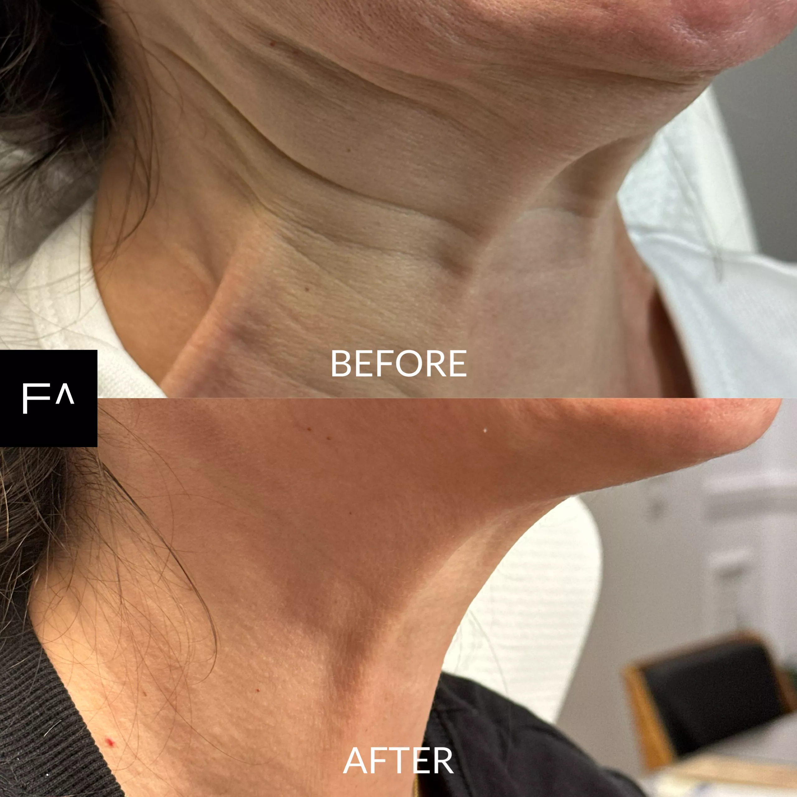 What’s the Difference Between Dysport and Botox?