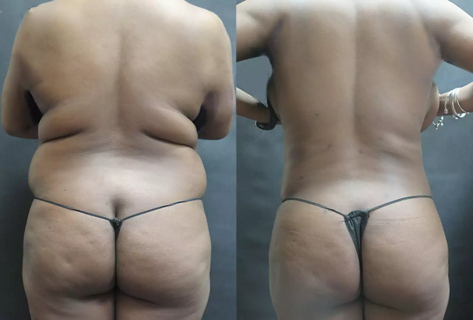 περιφέρεια σώματος πριν και μετά το bodytite.