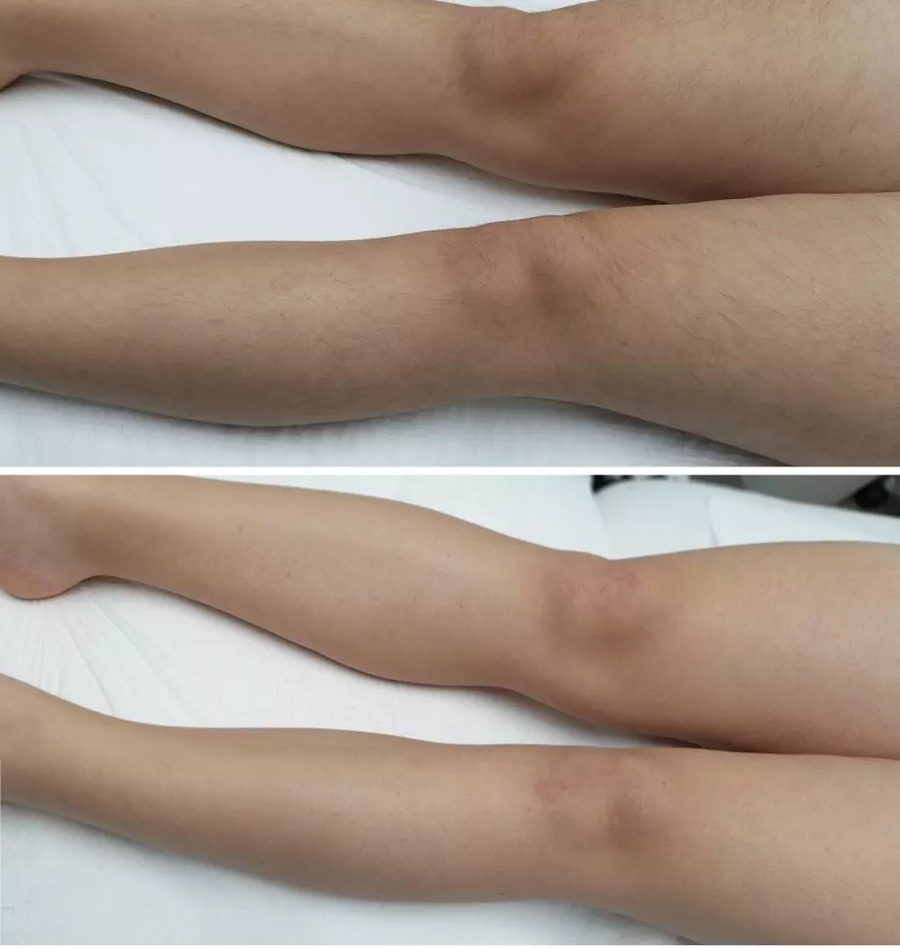 Αποτρίχωση στα πόδια με laser Αλεξανδρίτη πριν και μετά
