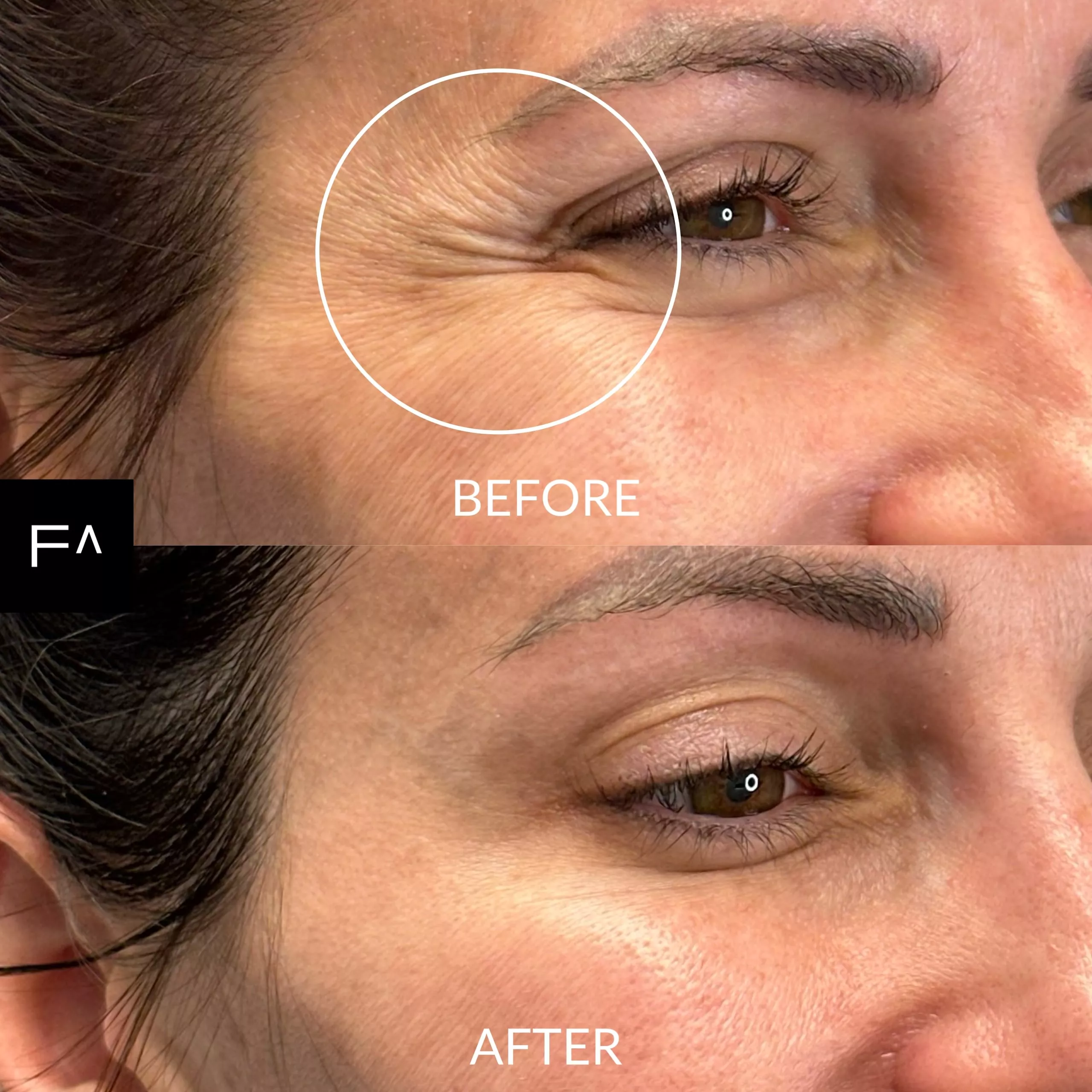 botox in eye wrinkles before and after