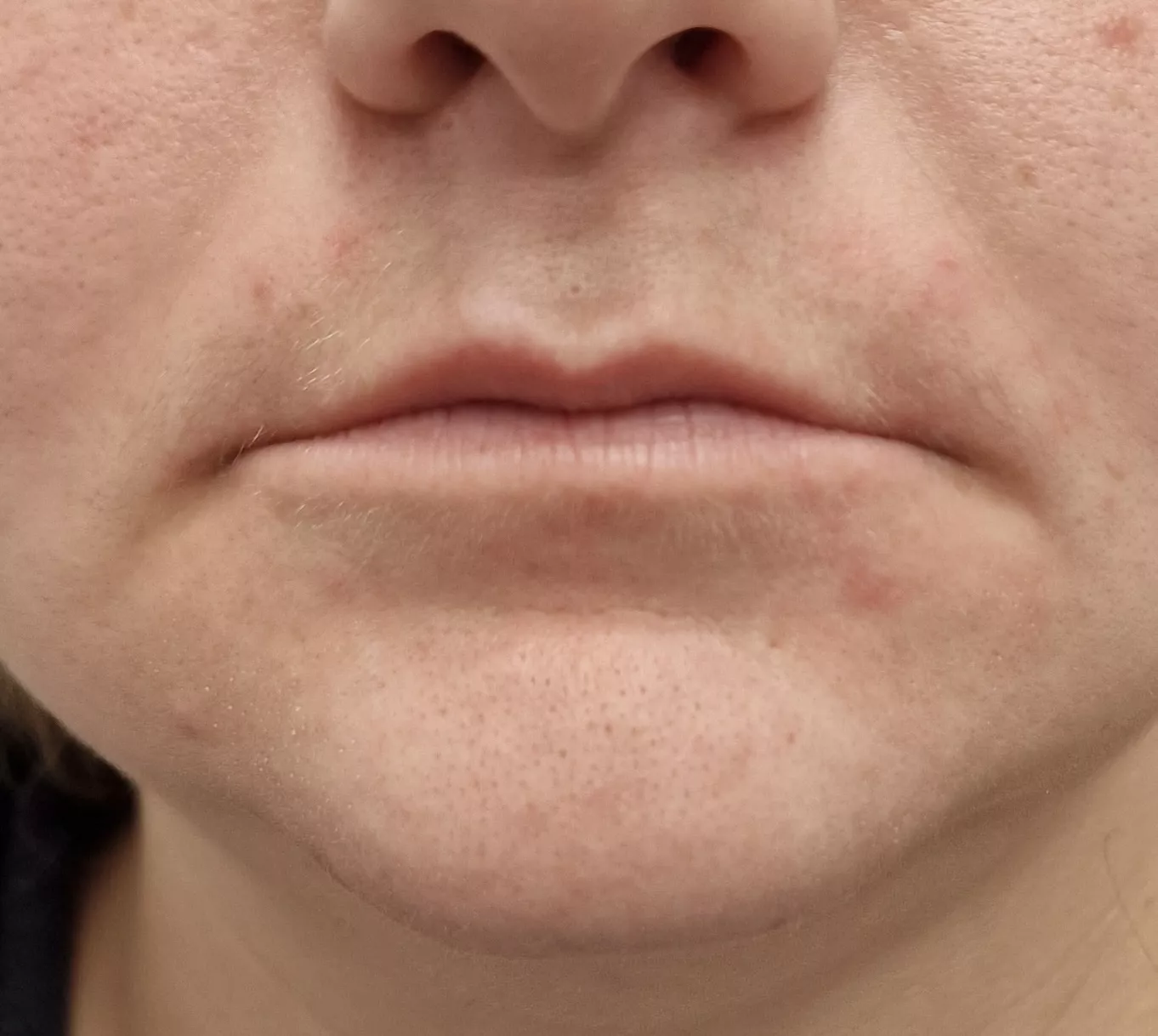 Hyaluronic acid on the lips before