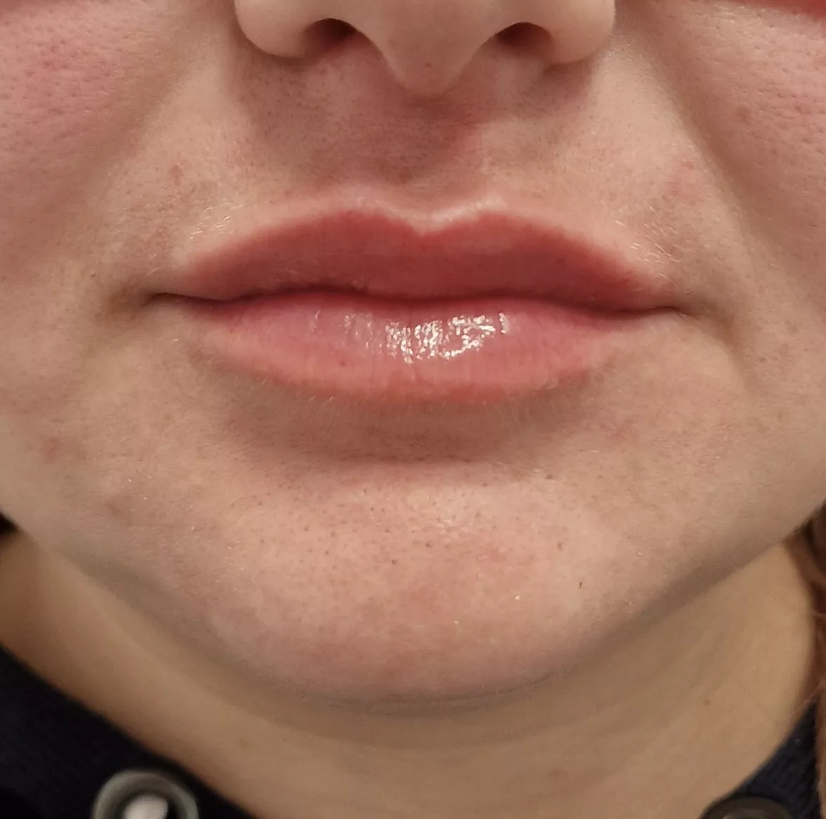Hyaluronic acid on the lips after