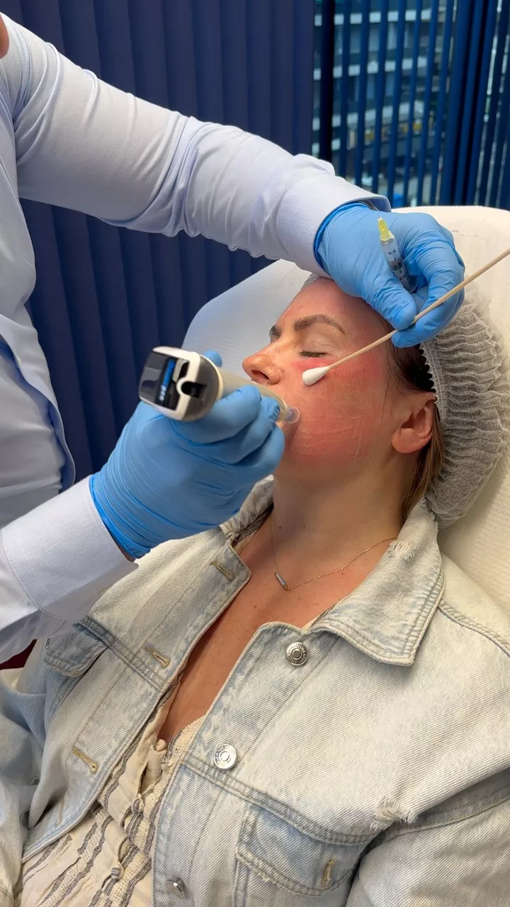 Dermapen ή fractional