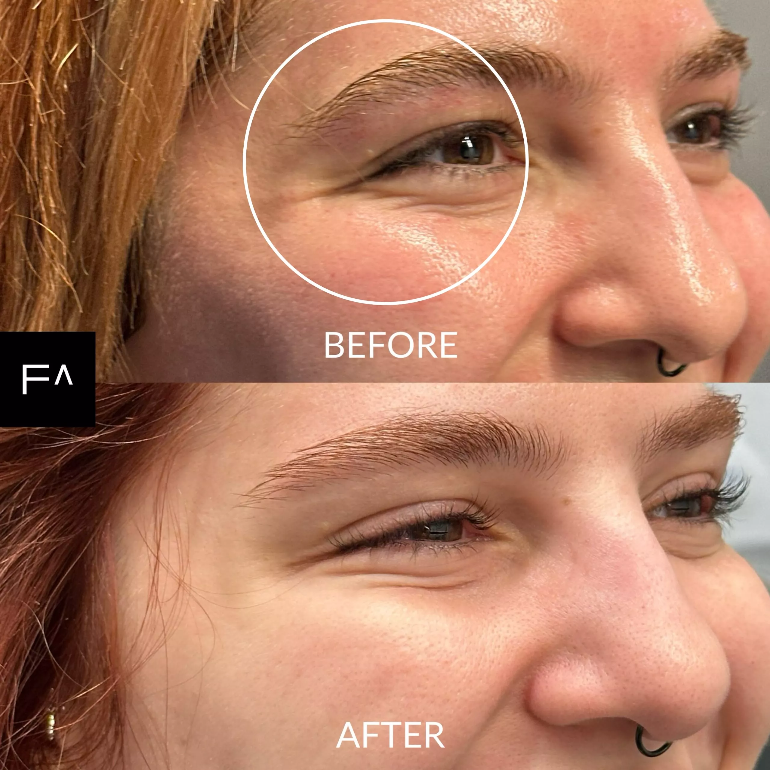 botox in eyes before and after