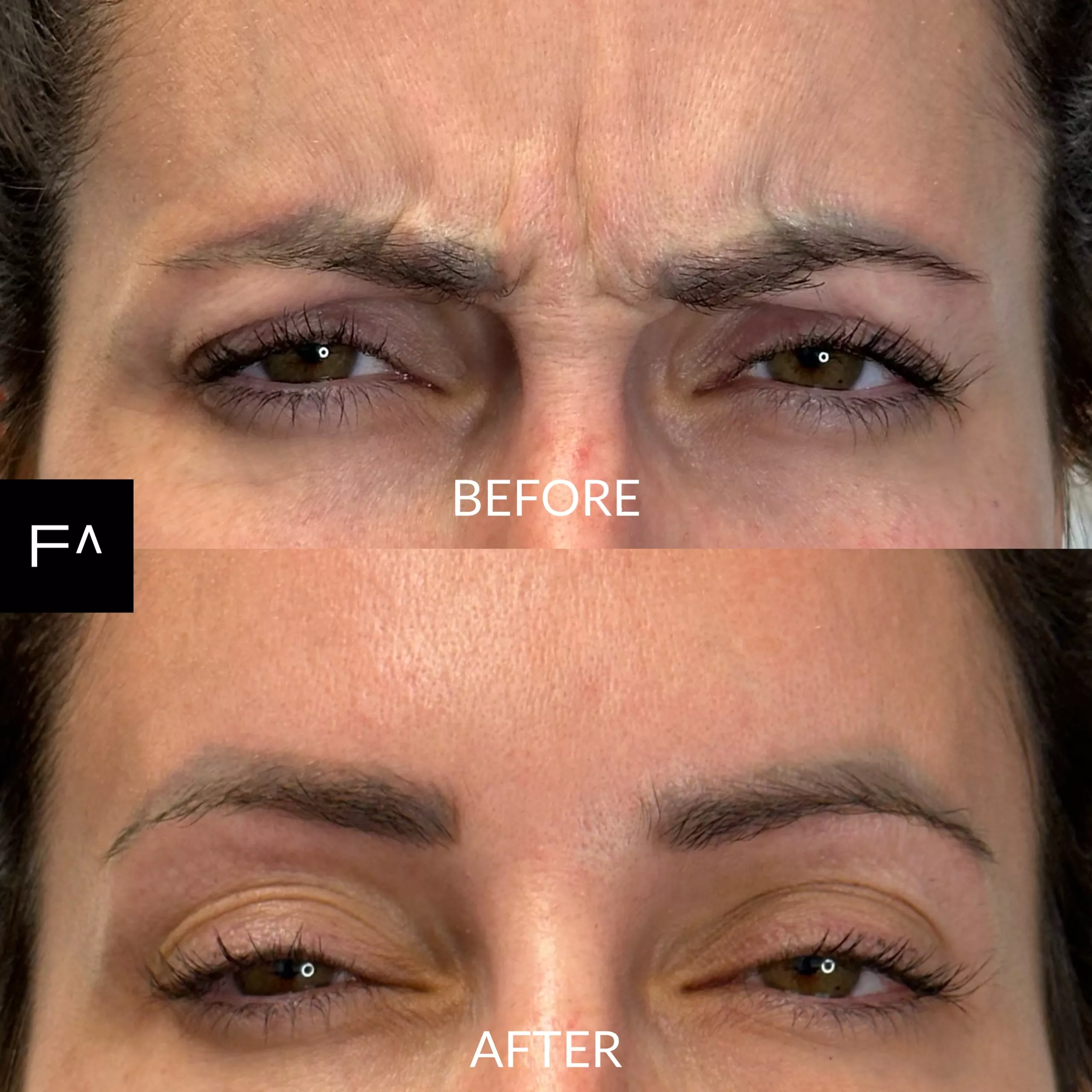 botox in eye wrinkles before and after