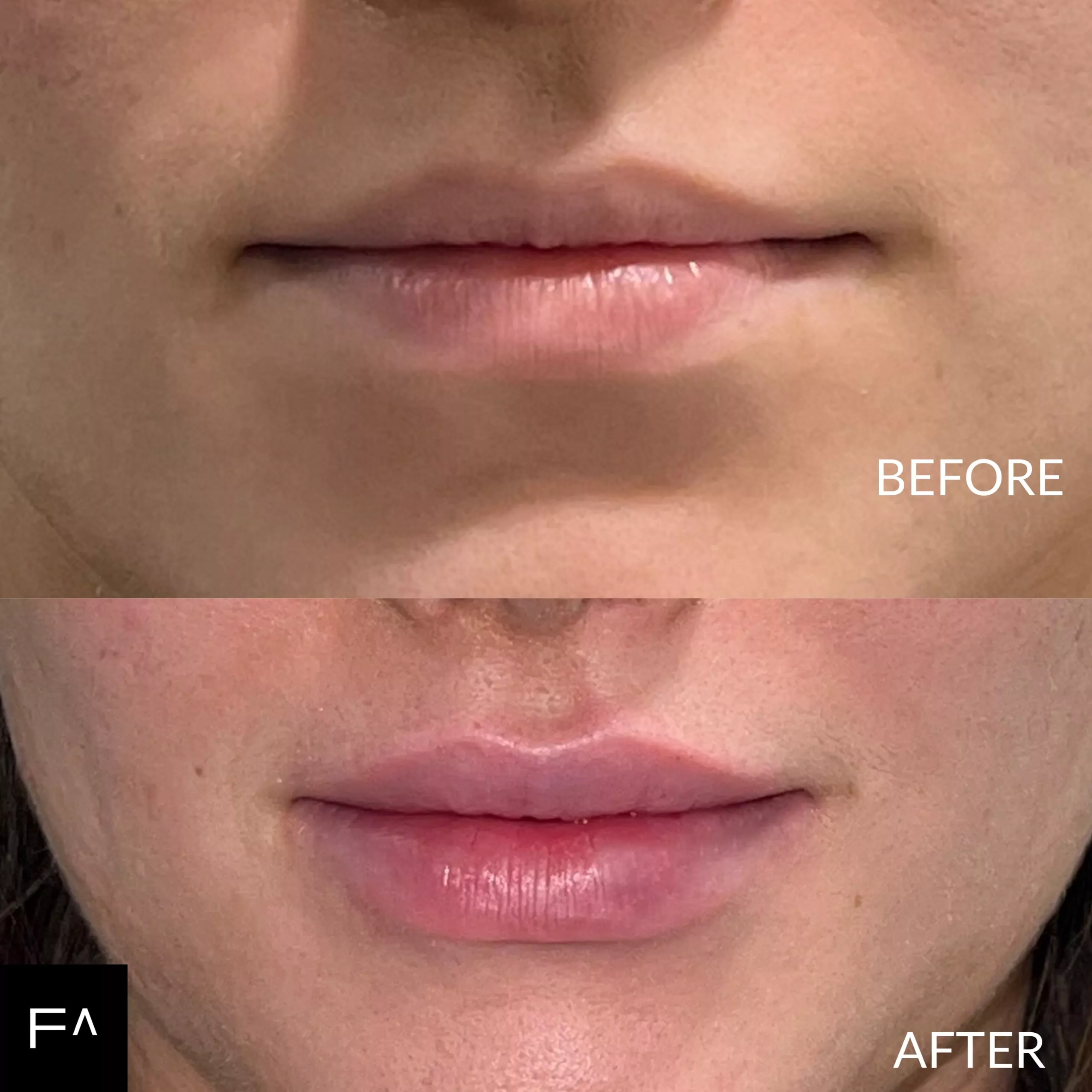 υαλουρονικo οξύ στα χείλη πριν και μετά