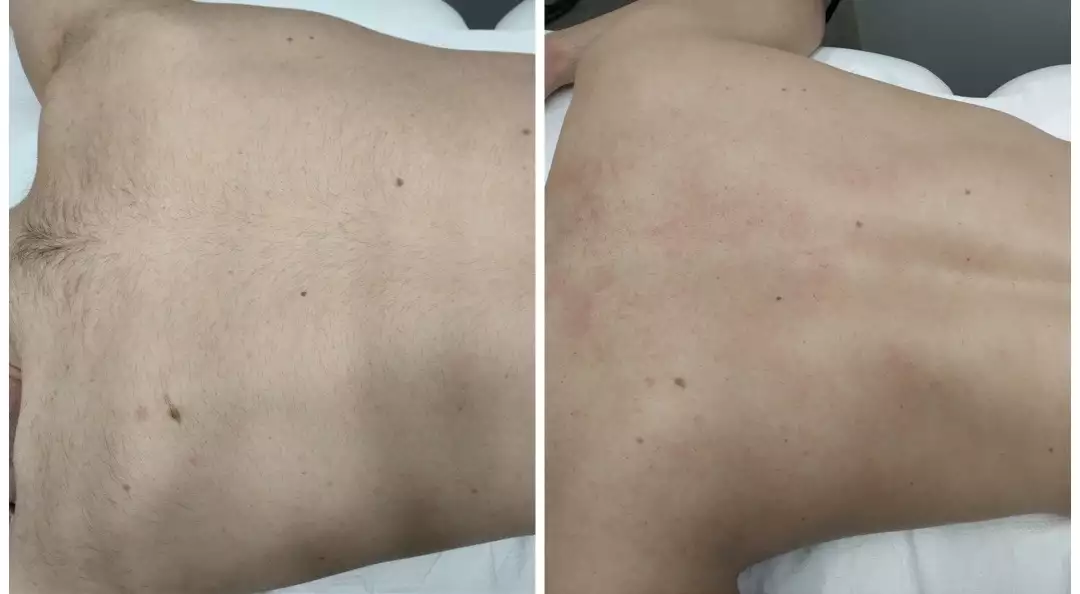 εικόνα πριν και μετά από αποτρίχωση με laser αλεξανδρίτη στην πλάτη άνδρες