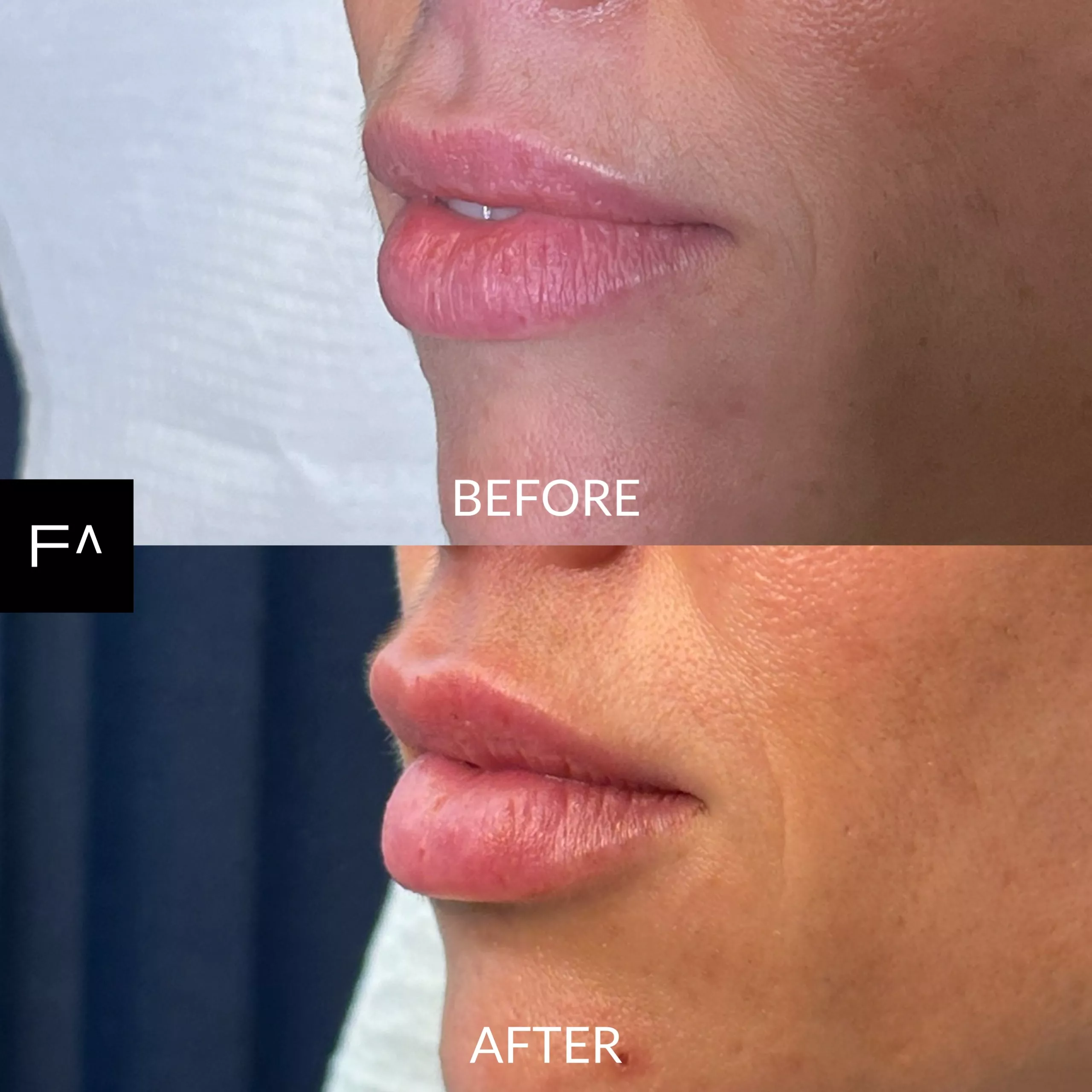 Hyaluronic acid on the lips
