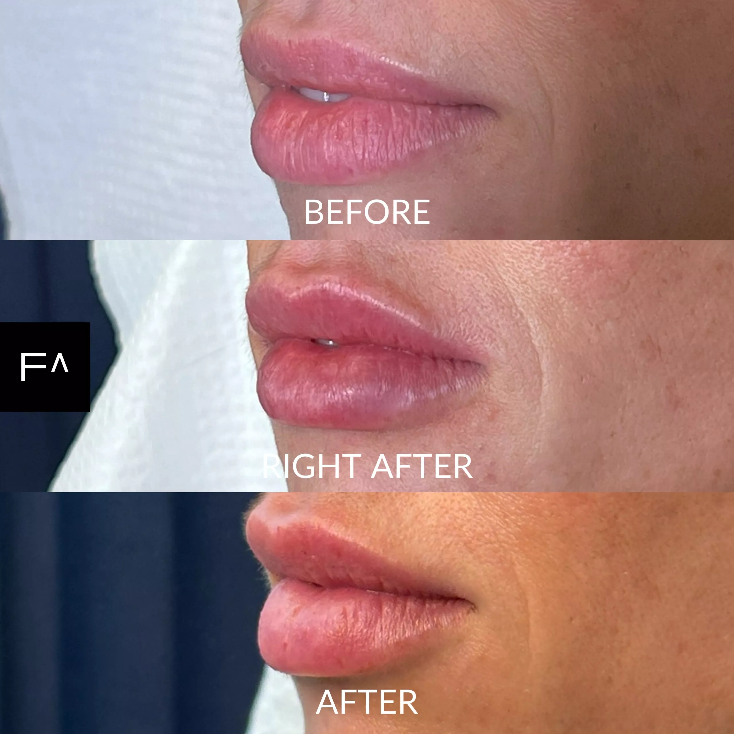 Hyaluronic acid on the lips