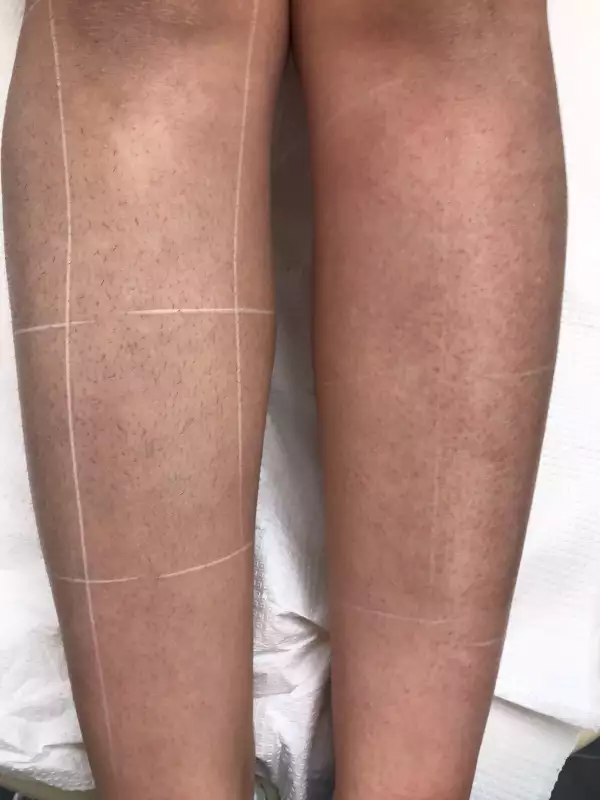  πριν & μετά από laser αποτρίχωση στα πόδια
