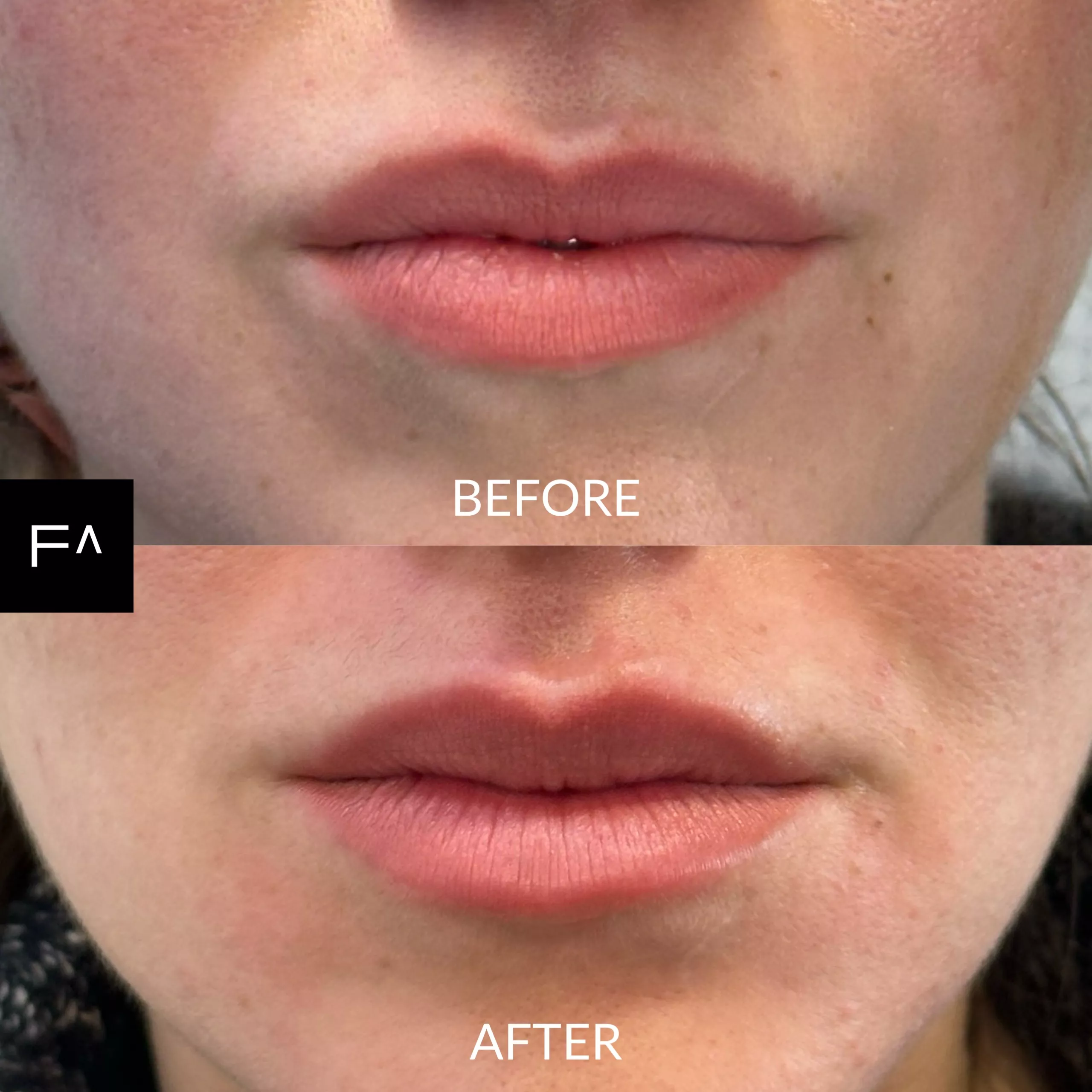Hyaluronic acid lips