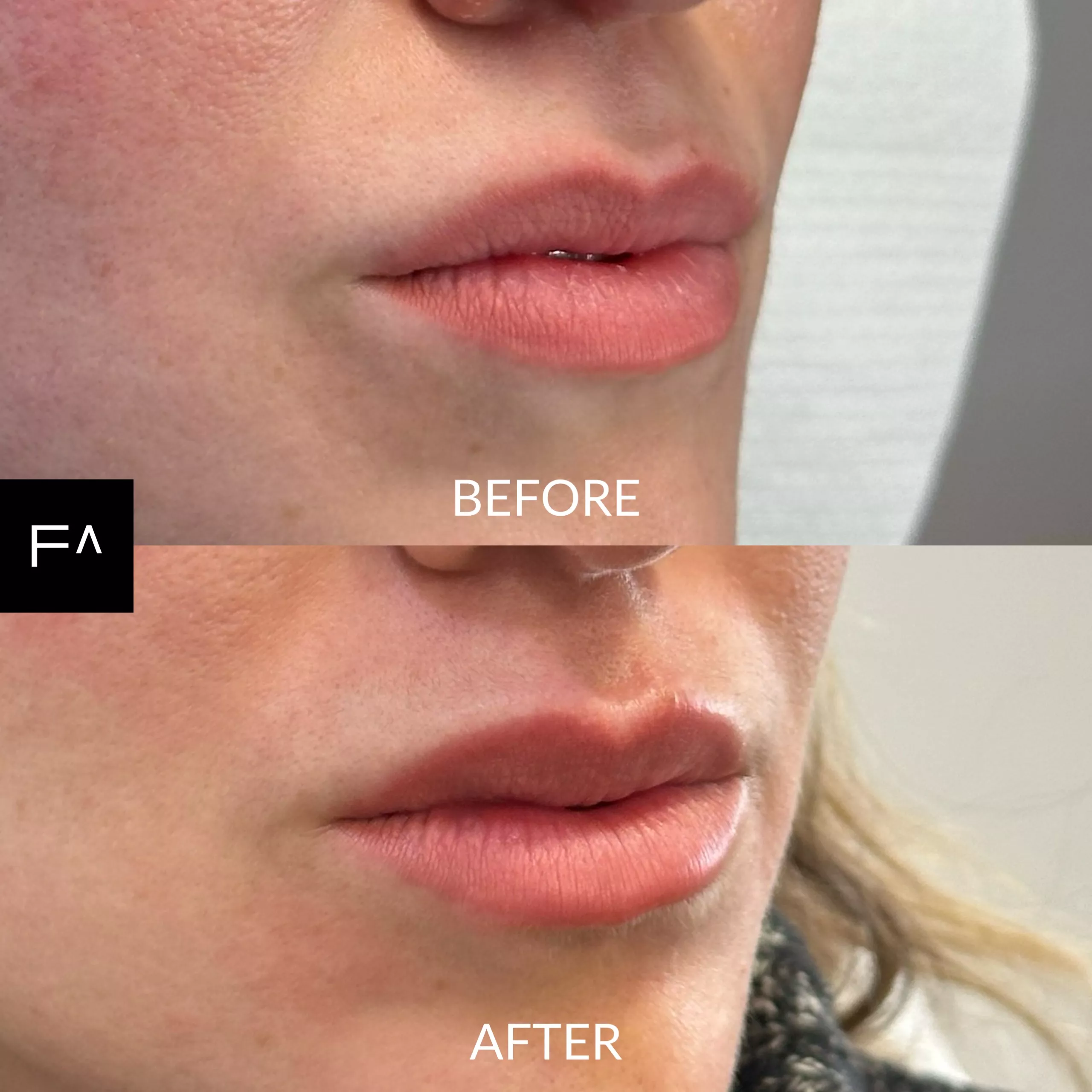 Hyaluronic on the lips