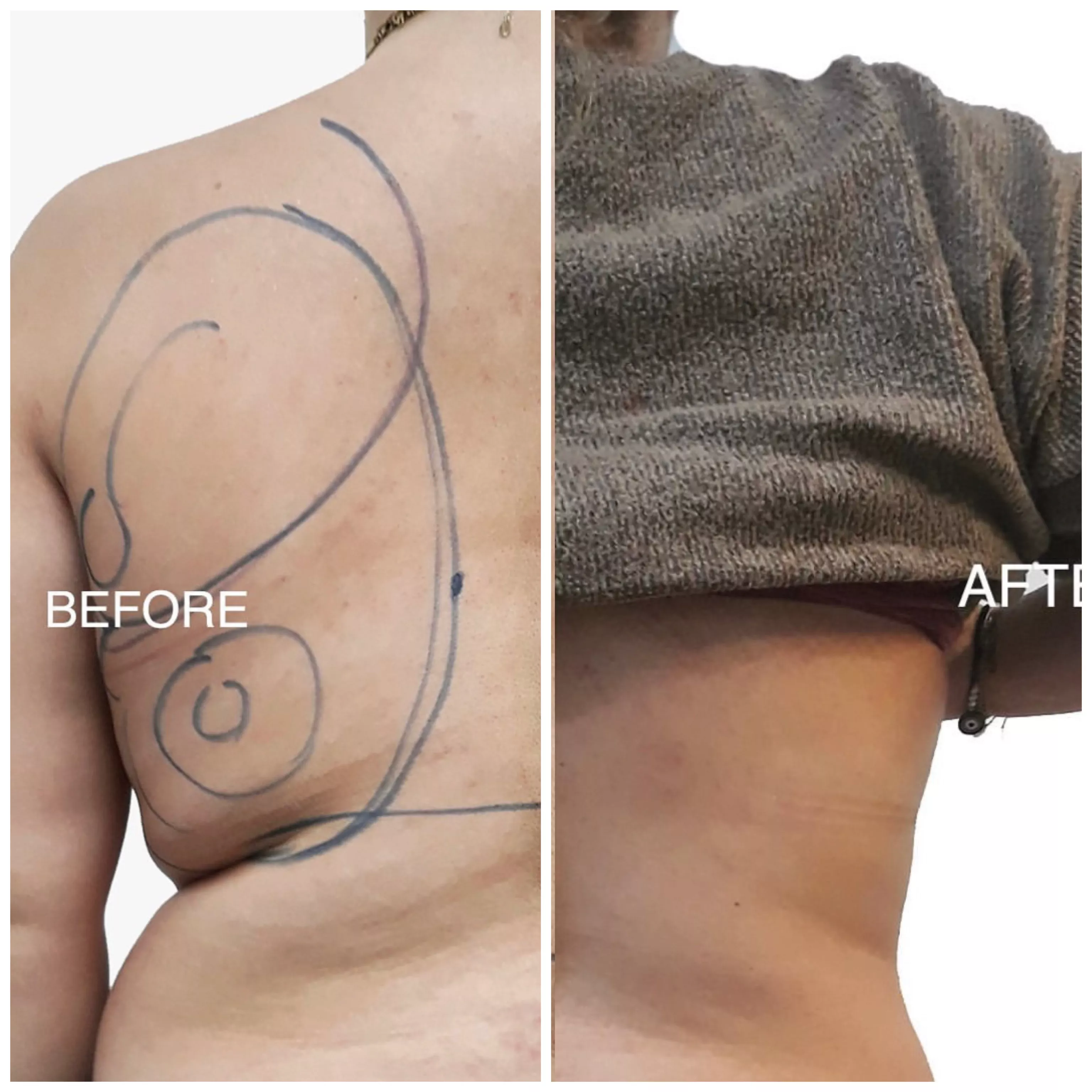 Λιποαναρρόφηση πριν και μετά