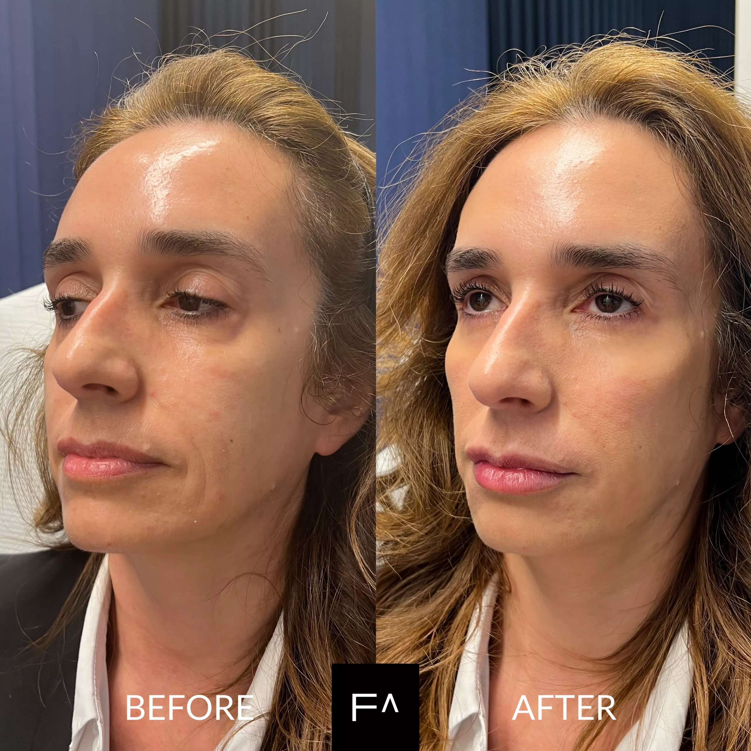 υαλουρονικό οξύ στο πρόσωπο πριν και μετά