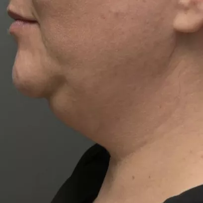 λιποαναρρόφηση