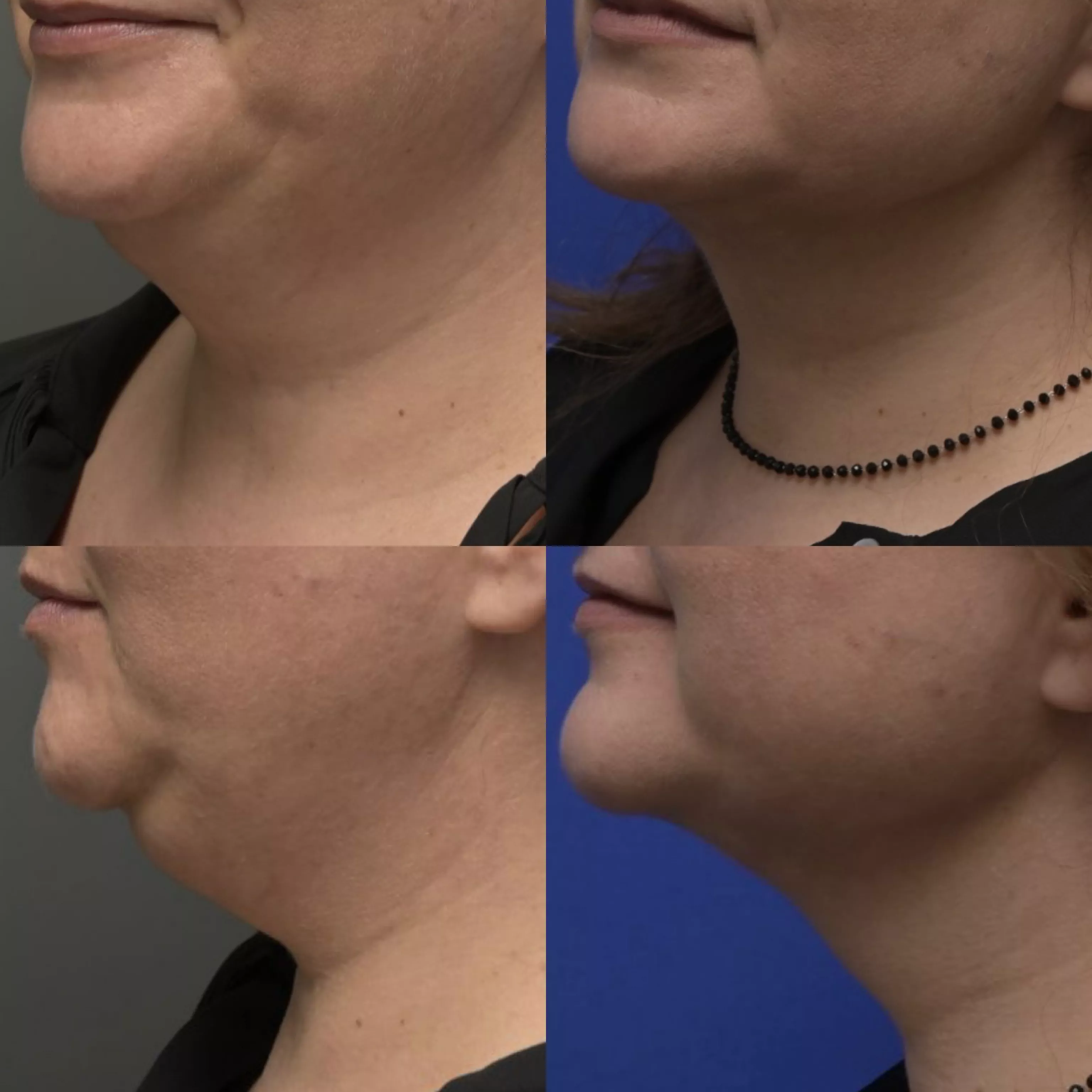 Λιποαναρρόφηση πριν και μετά