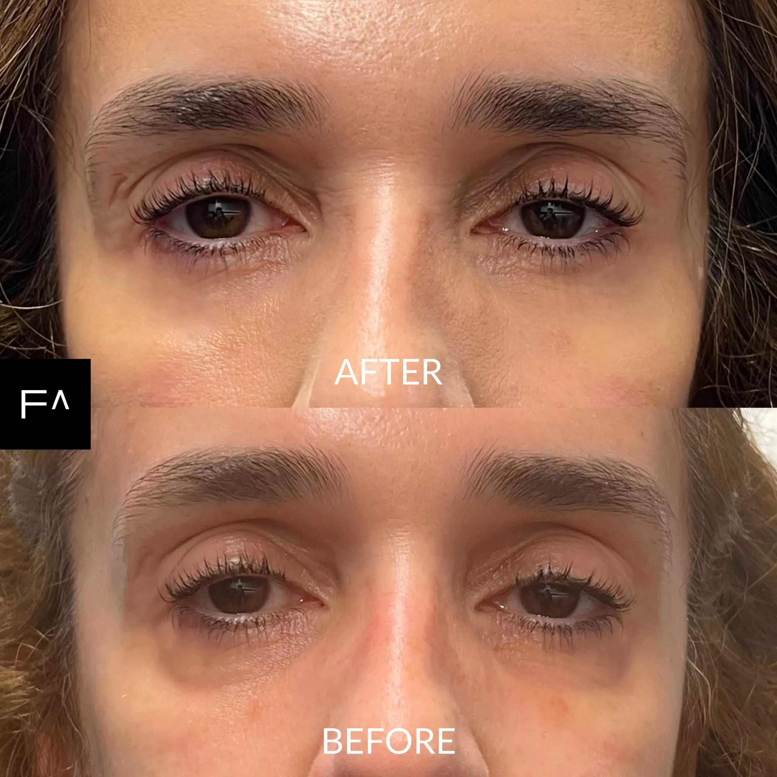 υαλουρονικό οξύ στα μάτια  πριν και μετά