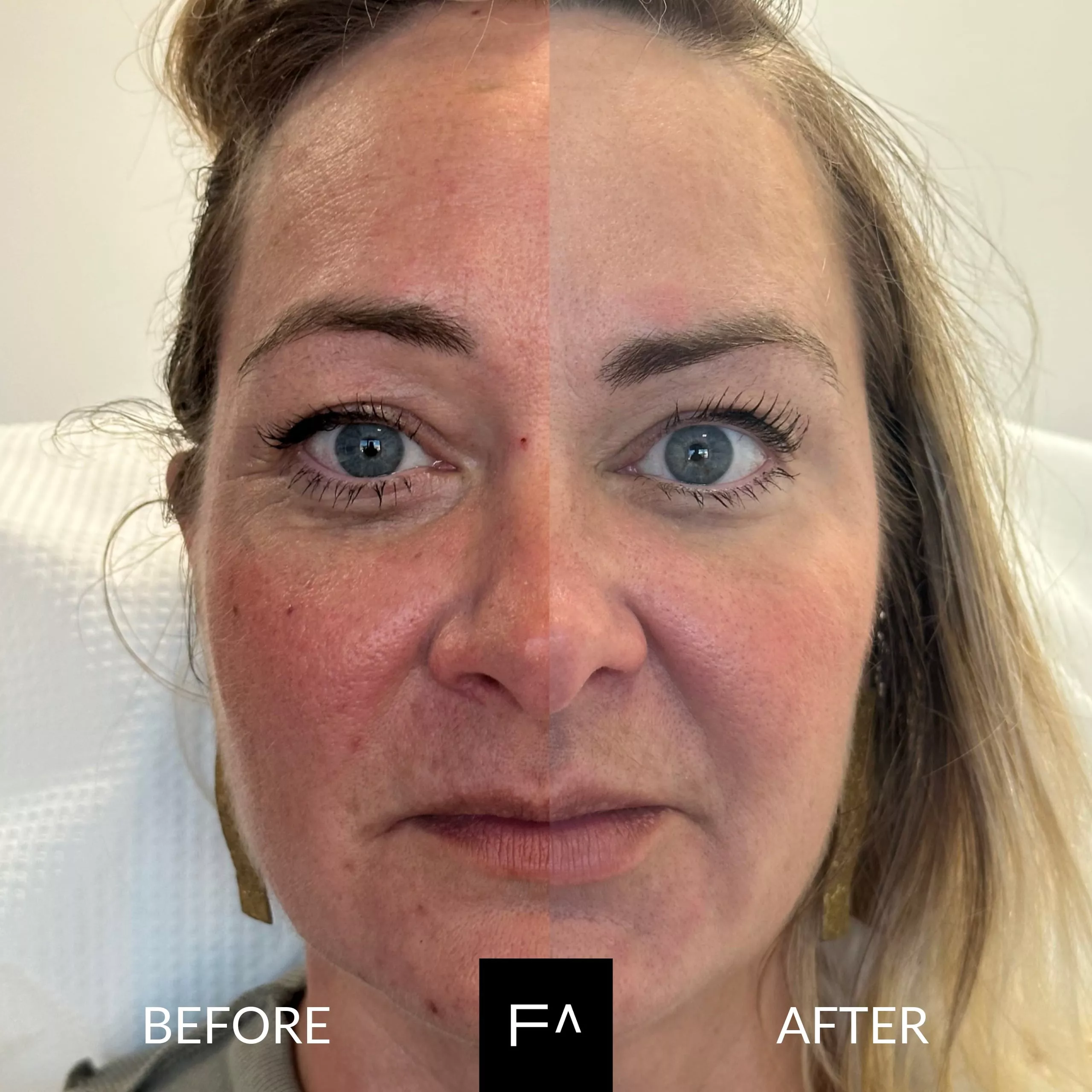 botox ρυτίδες before & after
