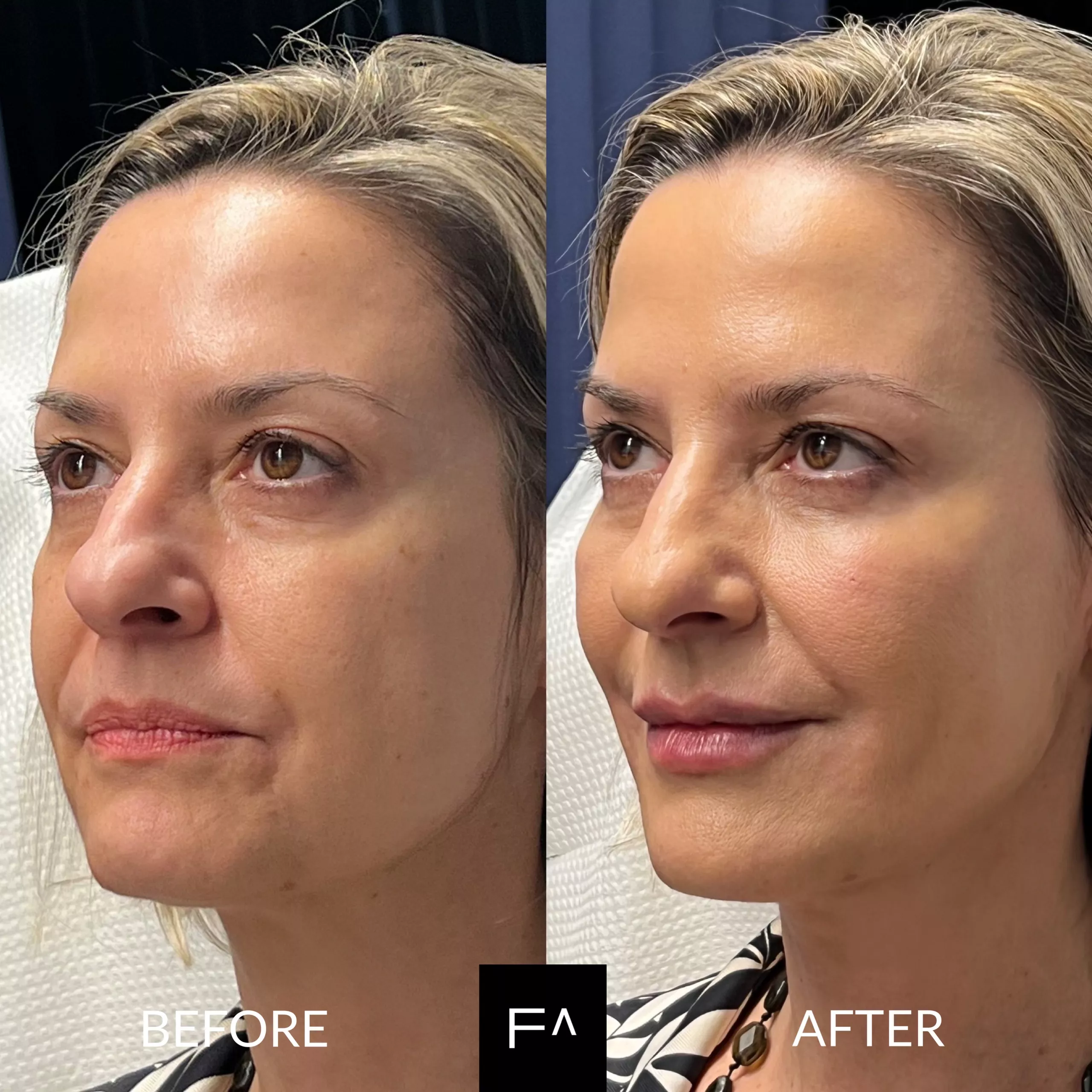 Beautification on woman 2 before & after