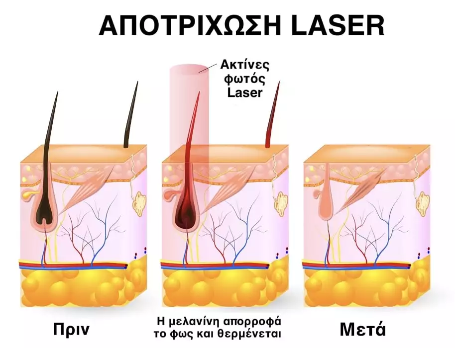 Πως λειτουργει η laser αποτριχωση Alexandriti