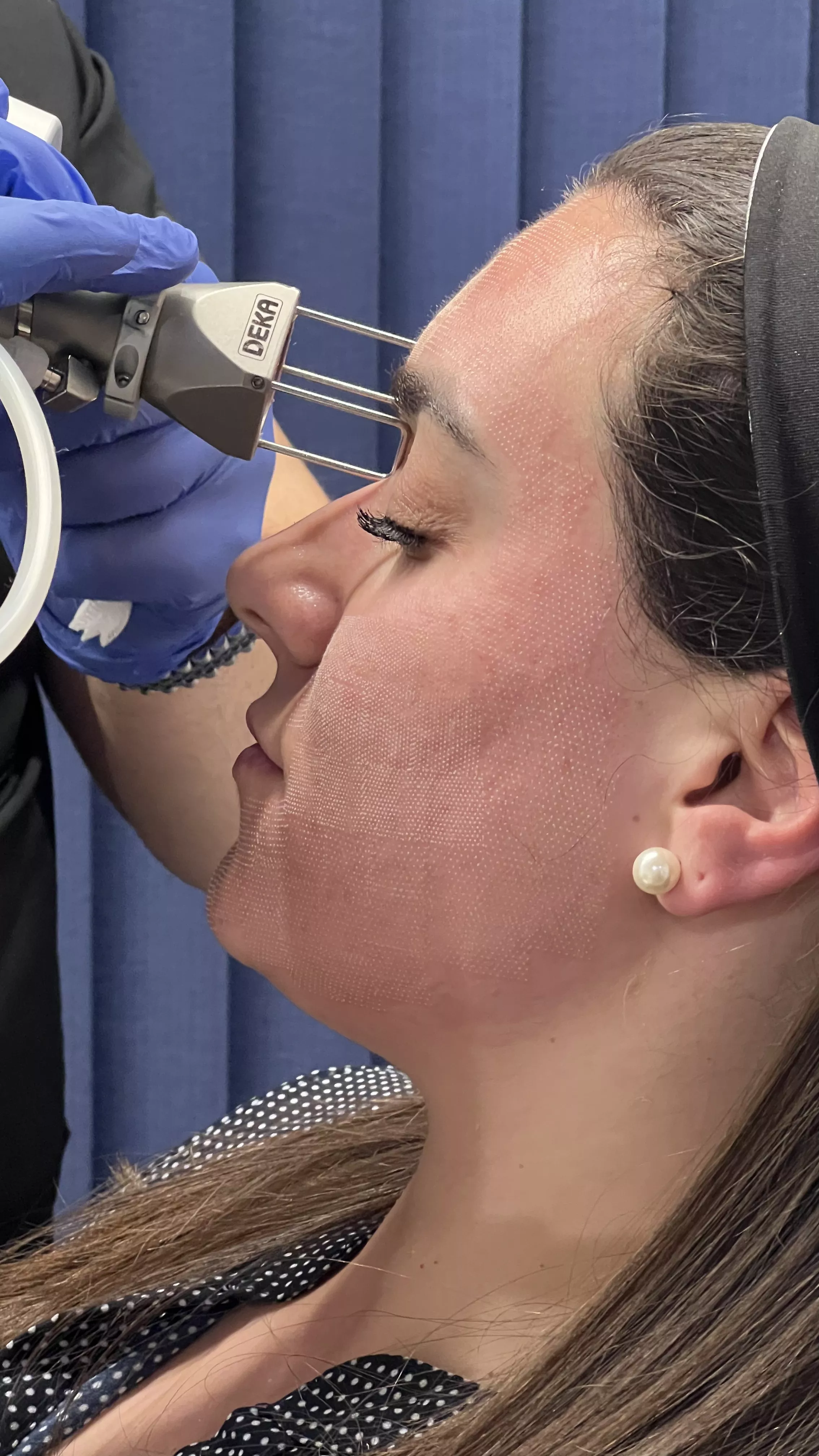 dermapen ή fractional laser