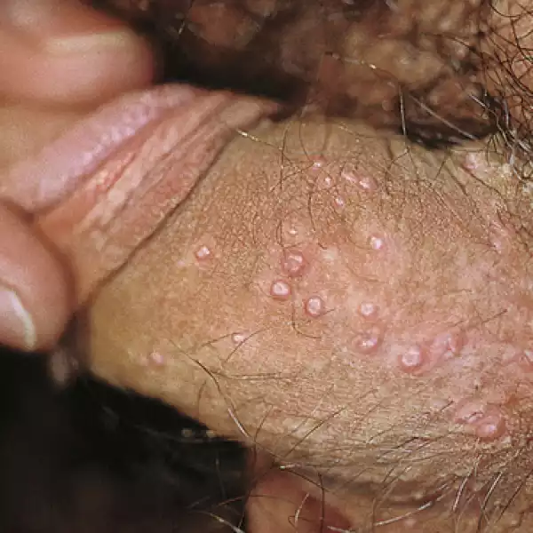 Κονδυλώματα: μολυσματική τέρμινθος στο πέος και φωτογραφίες ασθένειες πέους