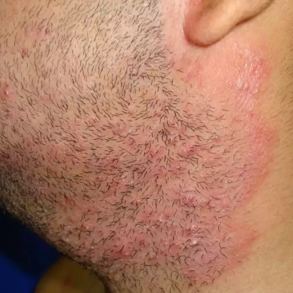 φωτογραφία θυλακίτιδα στο λαιμό άντρα από το ξύρισμα 
