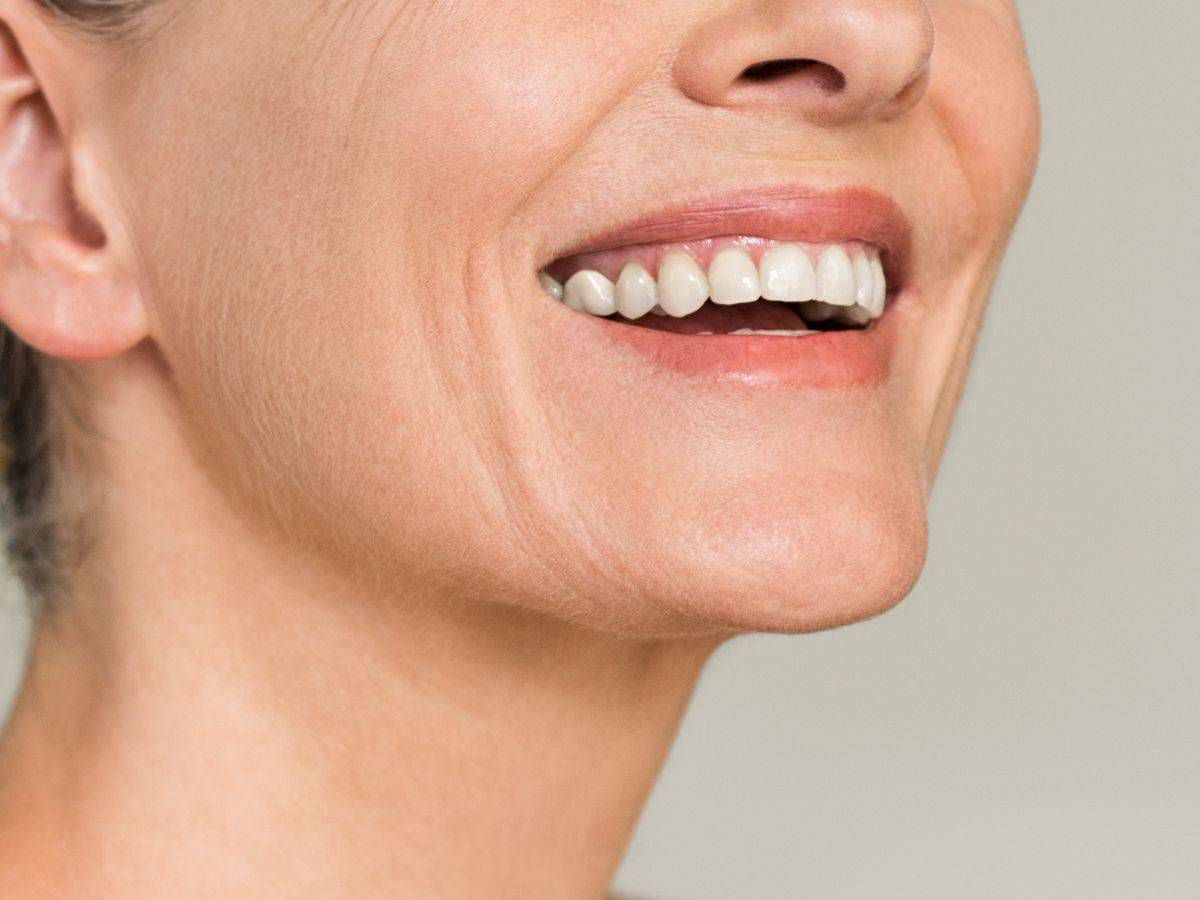 Υαλουρονικό στις ρυτίδες μαριονέτας: Πως βοηθάει