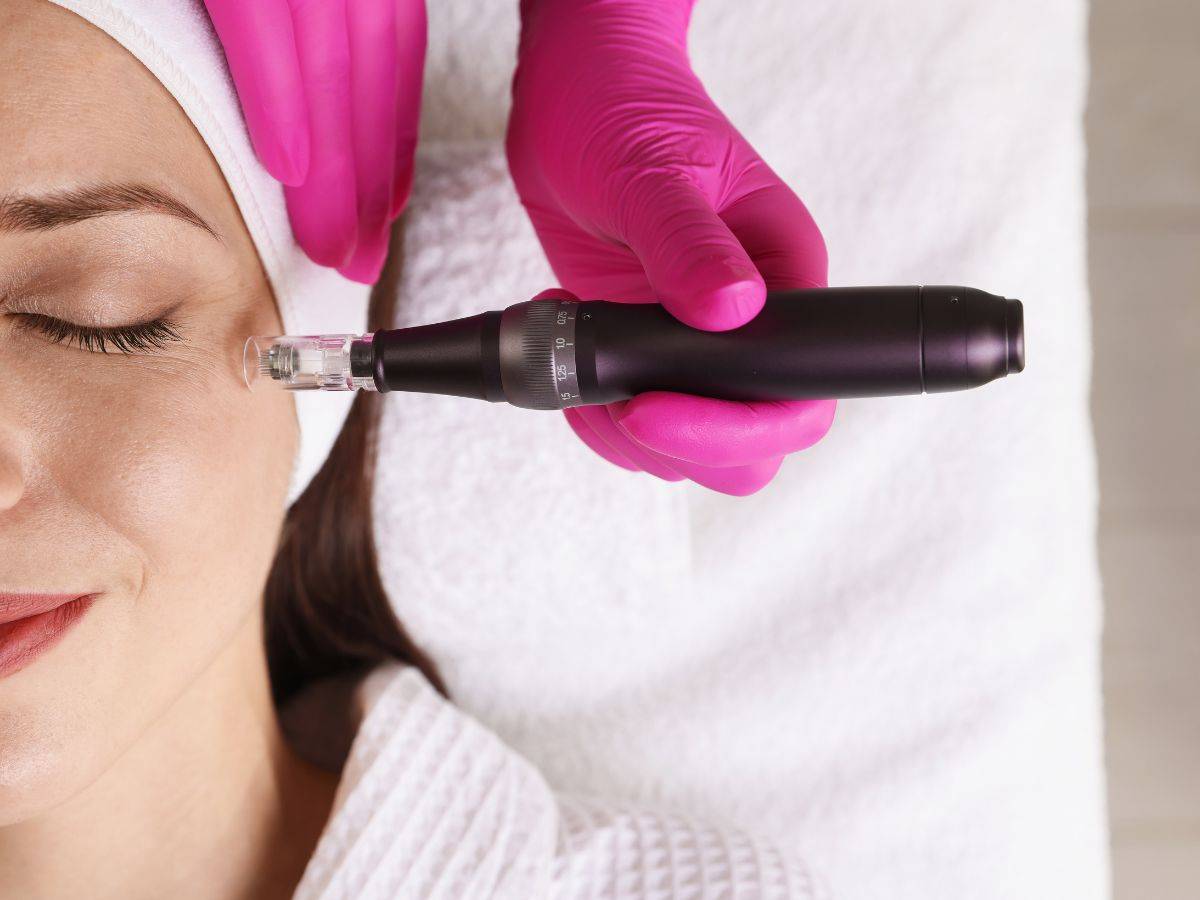 Dermapen με Εξωσώματα: Πώς Αναγεννά το Δέρμα