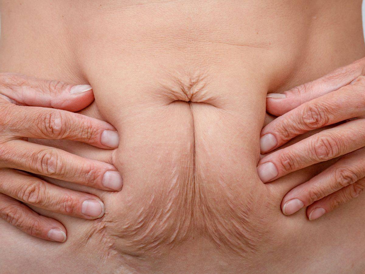 Χαλάρωση Μετά από Λιποαναρρόφηση: Γιατί Συμβαίνει & Λύσεις