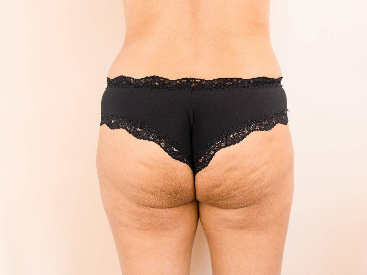 Κυτταρίτιδα στους γλουτούς: Πως αντιμετωπίζεται