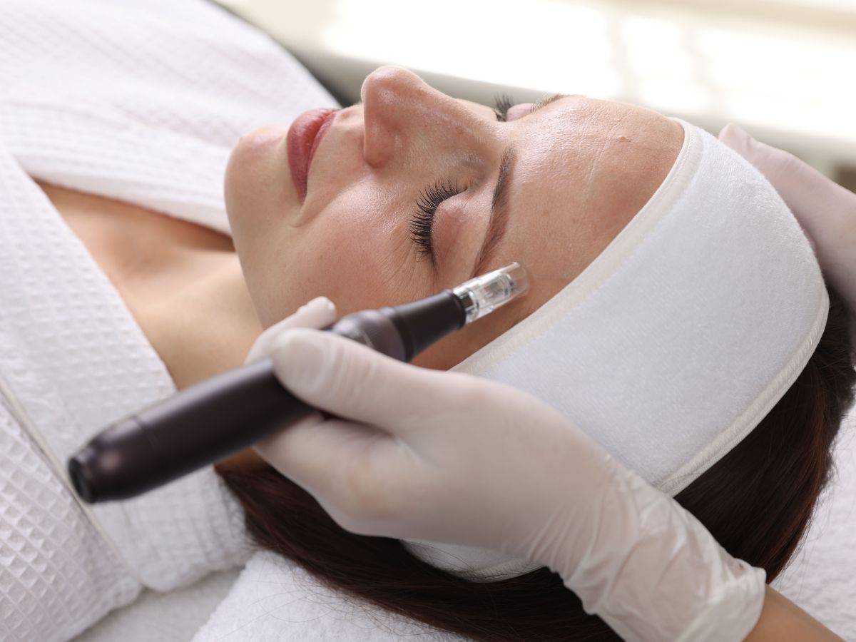 Microneedling Αθήνα: Φυσική Ανανέωση Επιδερμίδας