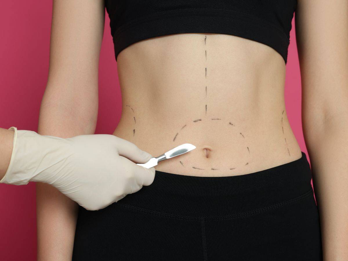 Featured image for article: Πρήξιμο μετά τη λιποαναρρόφηση: Τι να περιμένεις