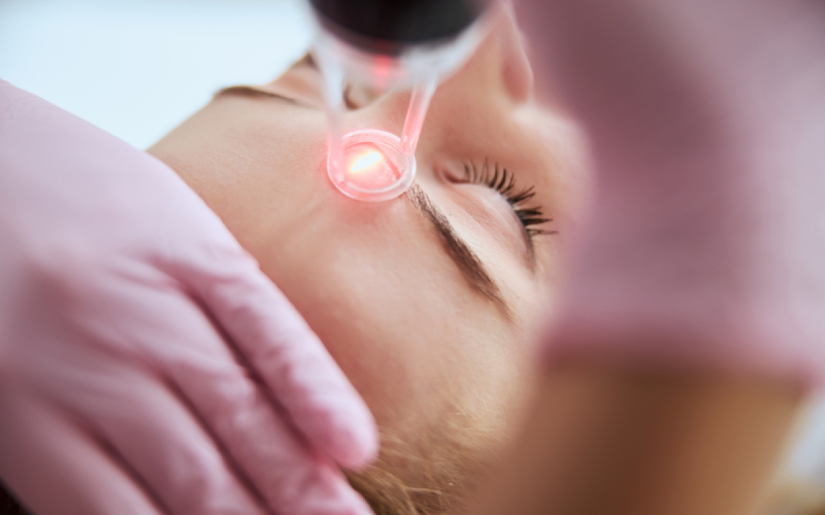 Dermapen ή fractional Laser; Τι να διαλέξεις