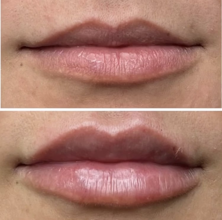 υαλουρονικό οξύ στα χείλη πριν και μετά