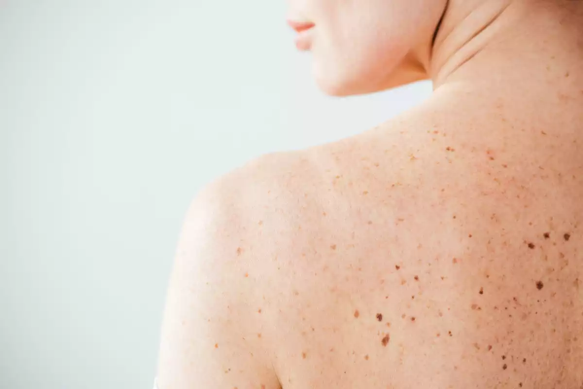 Καρκίνος του Δέρματος: ΔΕΡΜΑΙΟΣ, μήνας Ενημέρωσης & Πρόληψης